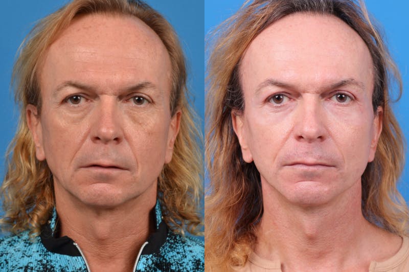 Facelift Before & After Gallery - Patient 122406145 - Image 1