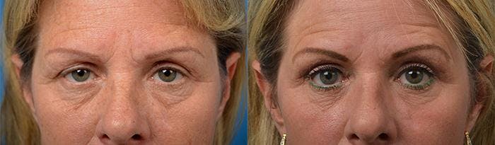 Eyelid Surgery Before & After Gallery - Patient 122406141 - Image 1