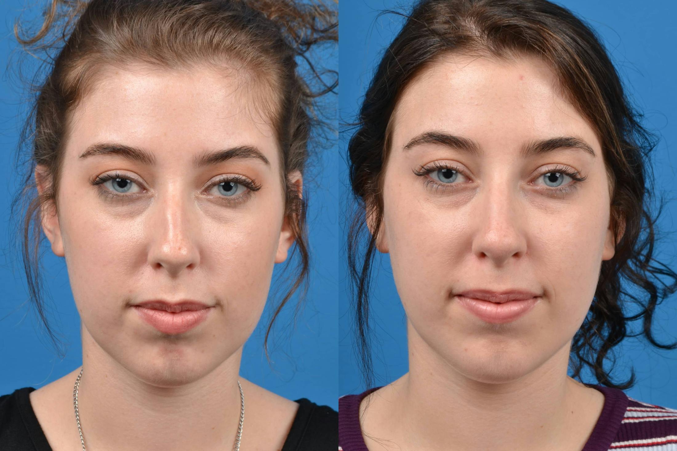Liquid Rhinoplasty Before & After Gallery - Patient 122406144 - Image 3
