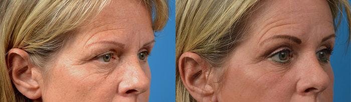 Eyelid Surgery Before & After Gallery - Patient 122406141 - Image 2
