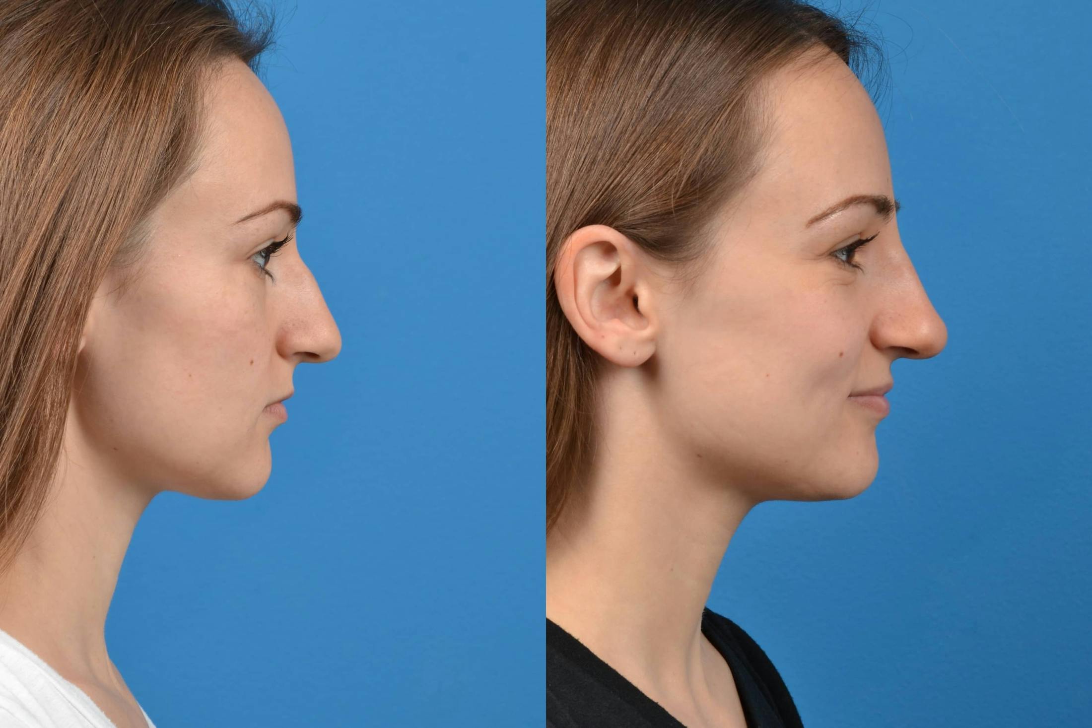 Liquid Rhinoplasty Before & After Gallery - Patient 122406146 - Image 1