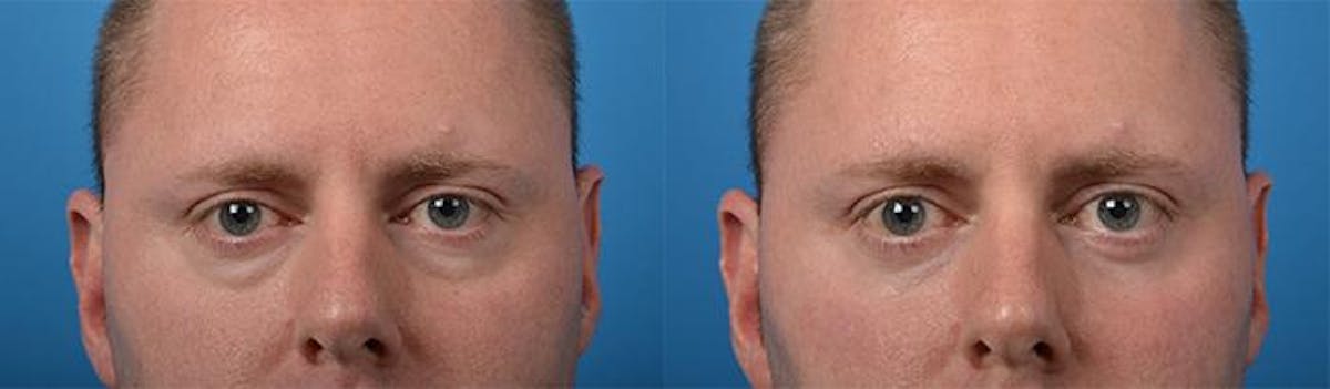 Eyelid Surgery Before & After Gallery - Patient 122406143 - Image 1