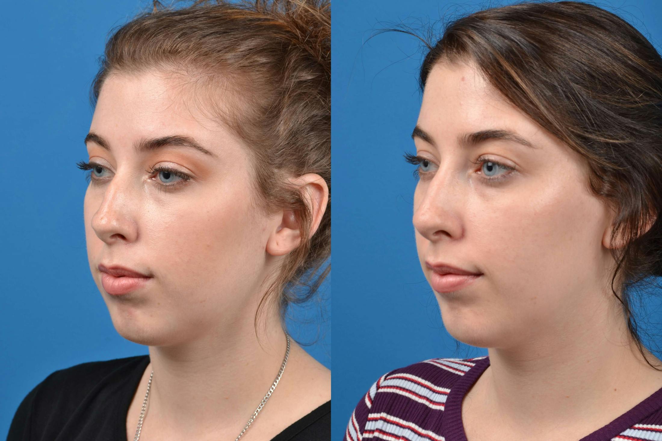 Liquid Rhinoplasty Before & After Gallery - Patient 122406144 - Image 4