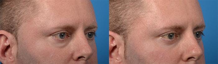 Eyelid Surgery Before & After Gallery - Patient 122406143 - Image 2