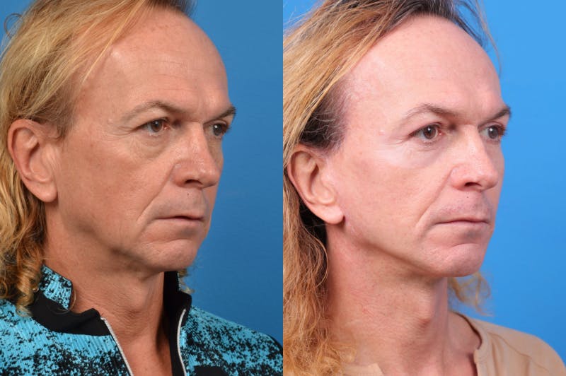 Facelift Before & After Gallery - Patient 122406145 - Image 2