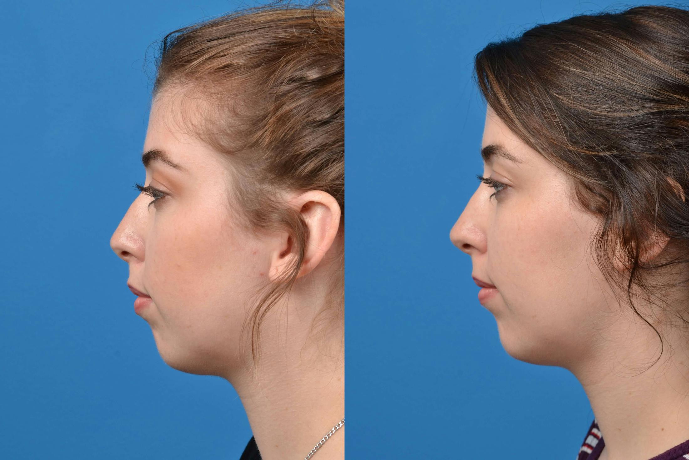 Liquid Rhinoplasty Before & After Gallery - Patient 122406144 - Image 5