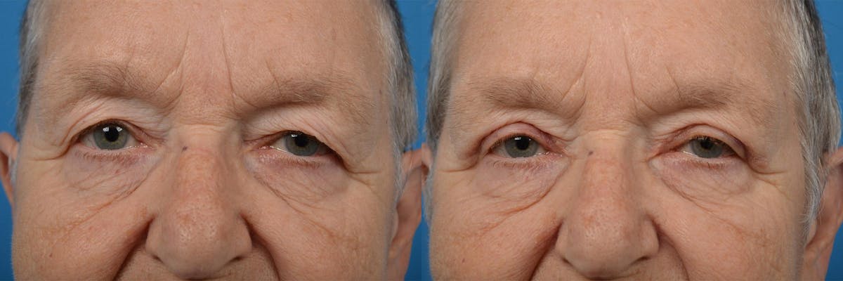 Eyelid Surgery Before & After Gallery - Patient 122406147 - Image 1