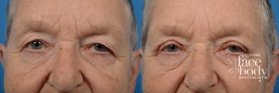 Eyelid Surgery Before & After Gallery - Patient 154498 - Image 1