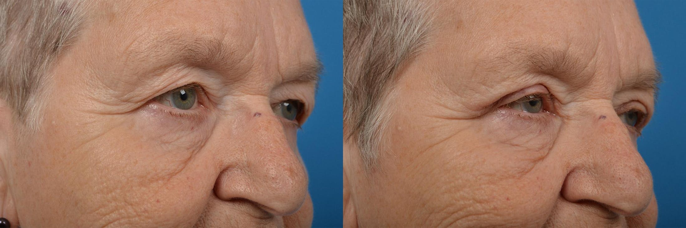 Eyelid Surgery Before & After Gallery - Patient 122406147 - Image 2