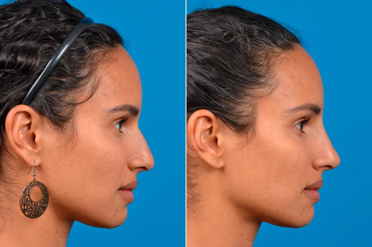 Liquid Rhinoplasty Before & After Gallery - Patient 122406148 - Image 1