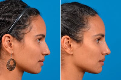 Liquid Rhinoplasty Before & After Gallery - Patient 122406148 - Image 1