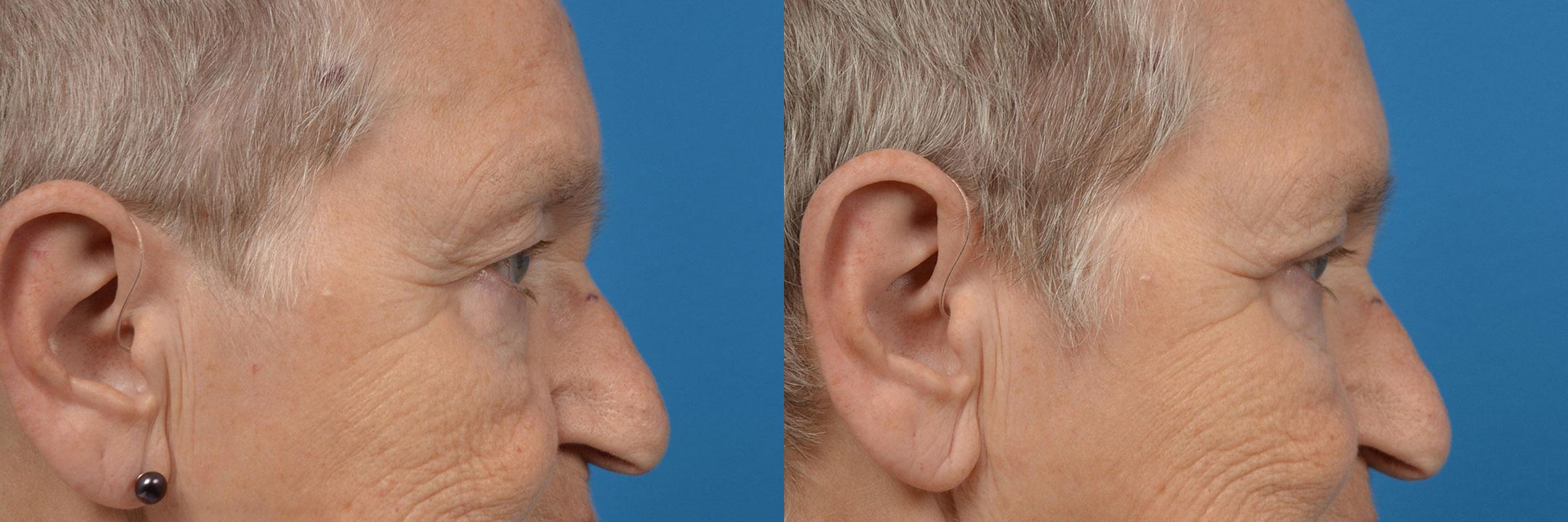 Eyelid Surgery Before & After Gallery - Patient 154498 - Image 3