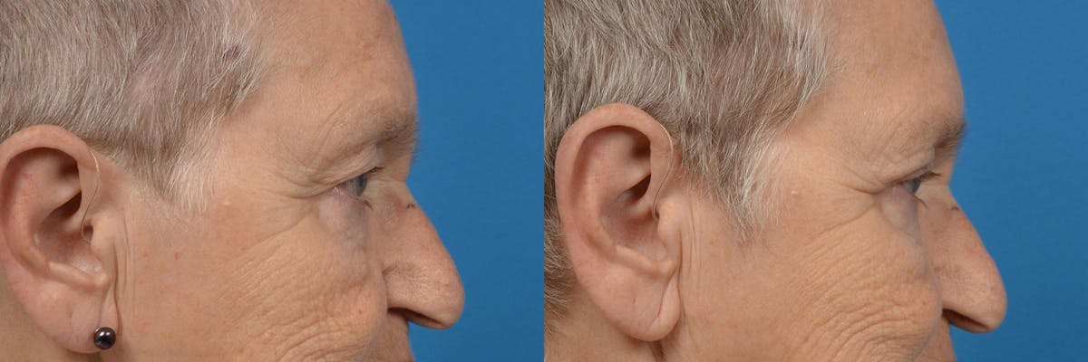 Eyelid Surgery Before & After Gallery - Patient 122406147 - Image 3