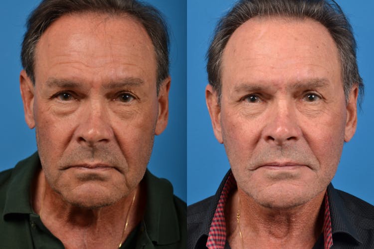 Facelift Before & After Gallery - Patient 122406149 - Image 1