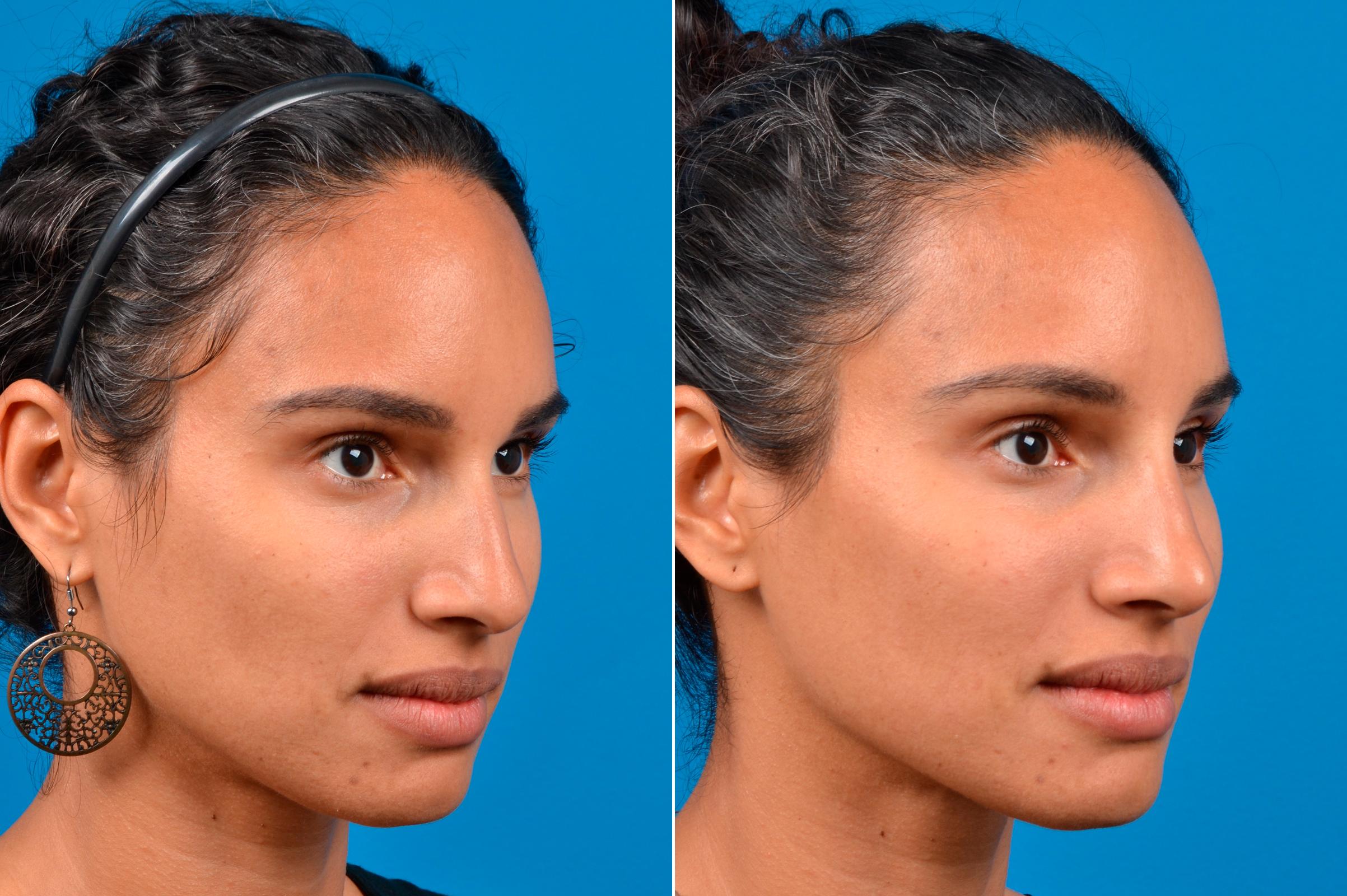 Liquid Rhinoplasty Before & After Gallery - Patient 122406148 - Image 2