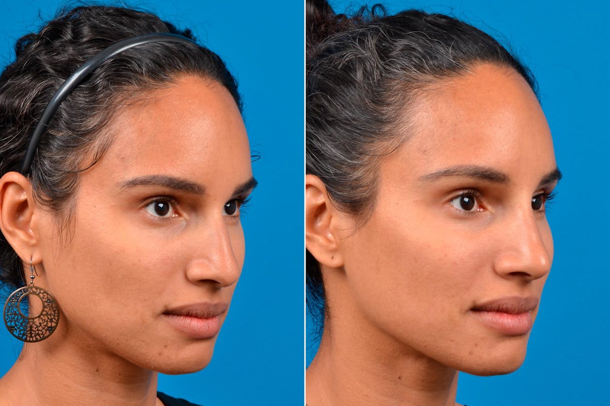 Liquid Rhinoplasty Before & After Gallery - Patient 122406148 - Image 2