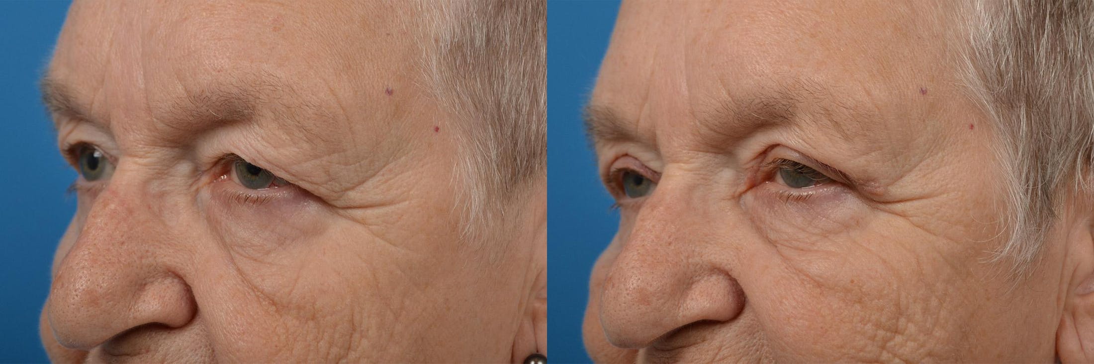 Eyelid Surgery Before & After Gallery - Patient 122406147 - Image 4