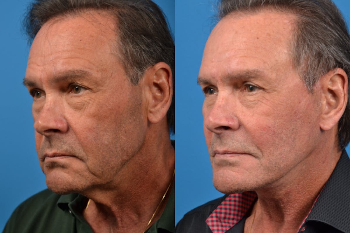 Facelift Before & After Gallery - Patient 122406149 - Image 2