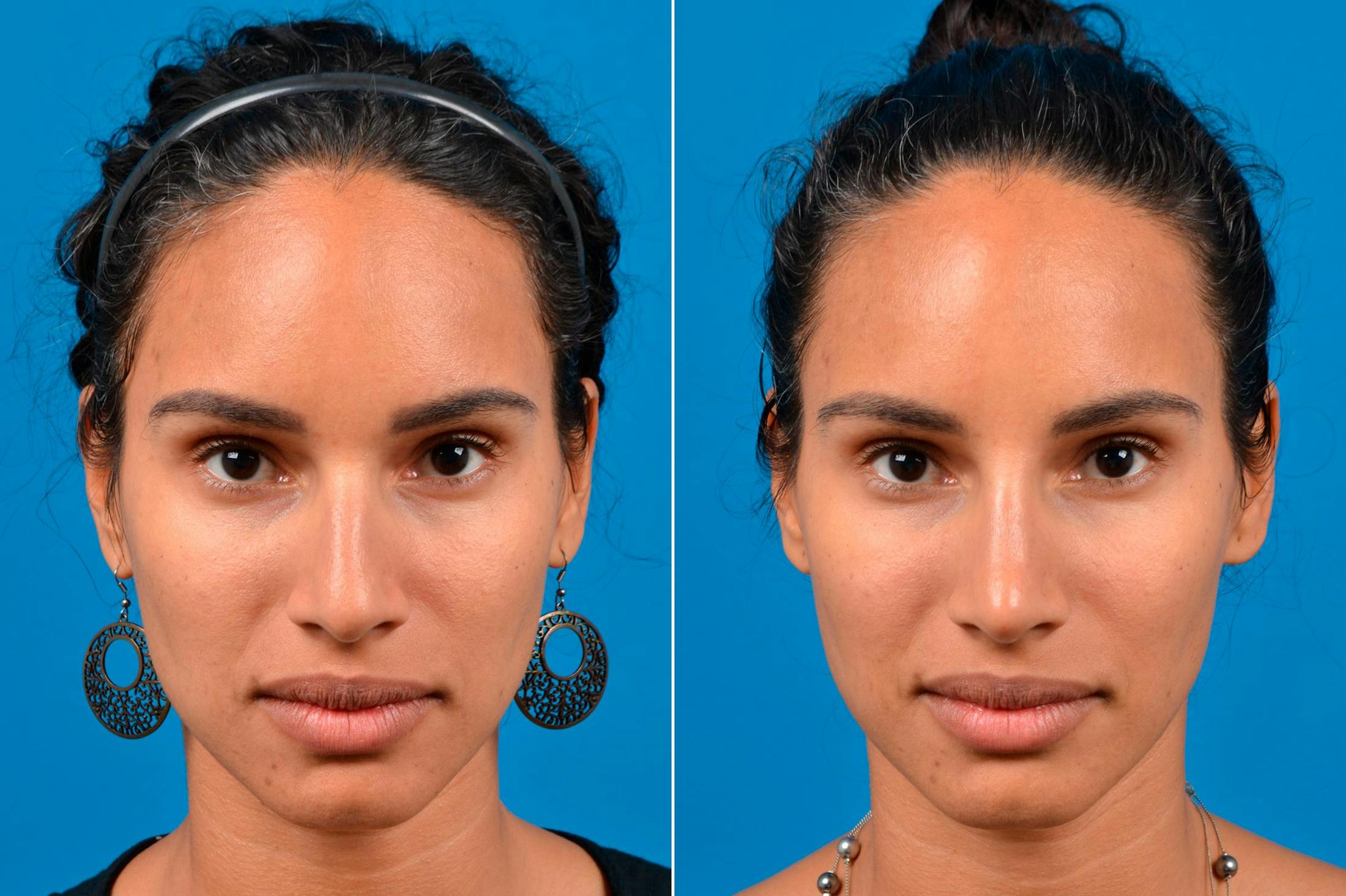 Liquid Rhinoplasty Before & After Gallery - Patient 122406148 - Image 3