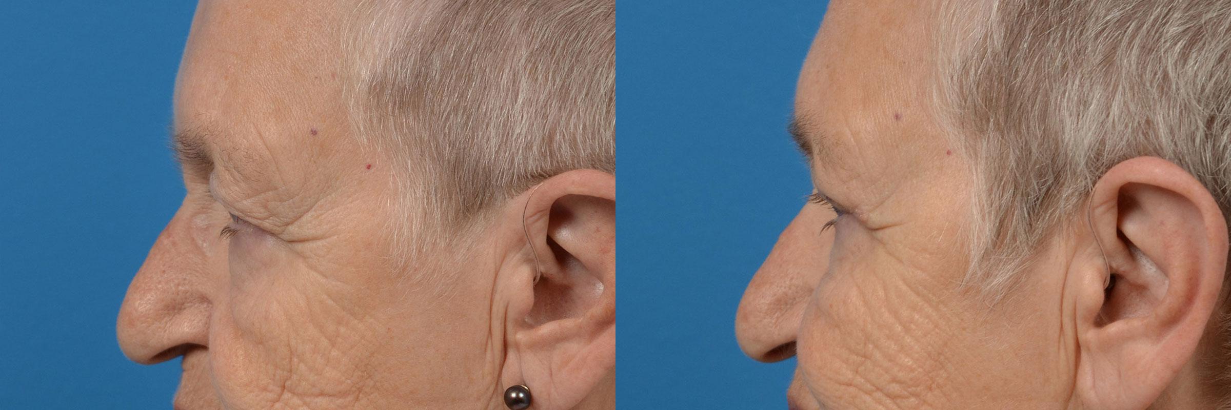 Eyelid Surgery Before & After Gallery - Patient 154498 - Image 5