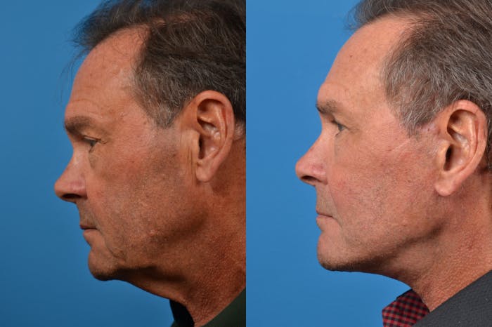 Facelift Before & After Gallery - Patient 122406149 - Image 3