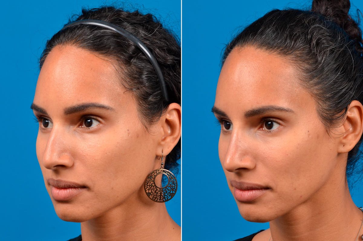 Liquid Rhinoplasty Before & After Gallery - Patient 122406148 - Image 4