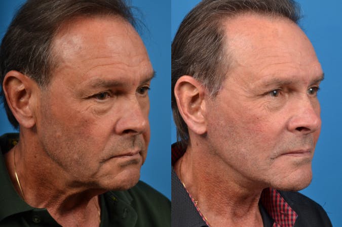 Facelift Before & After Gallery - Patient 122406149 - Image 4