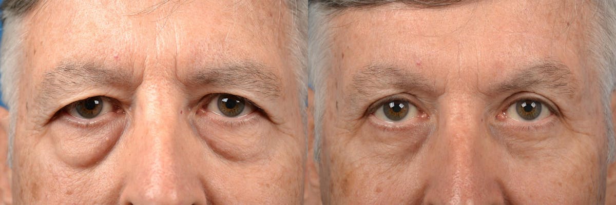 Eyelid Surgery Before & After Gallery - Patient 122406151 - Image 1