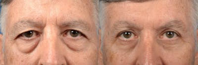 Eyelid Surgery Before & After Gallery - Patient 122406151 - Image 1