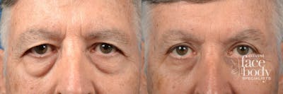 Eyelid Surgery Before & After Gallery - Patient 400054 - Image 1