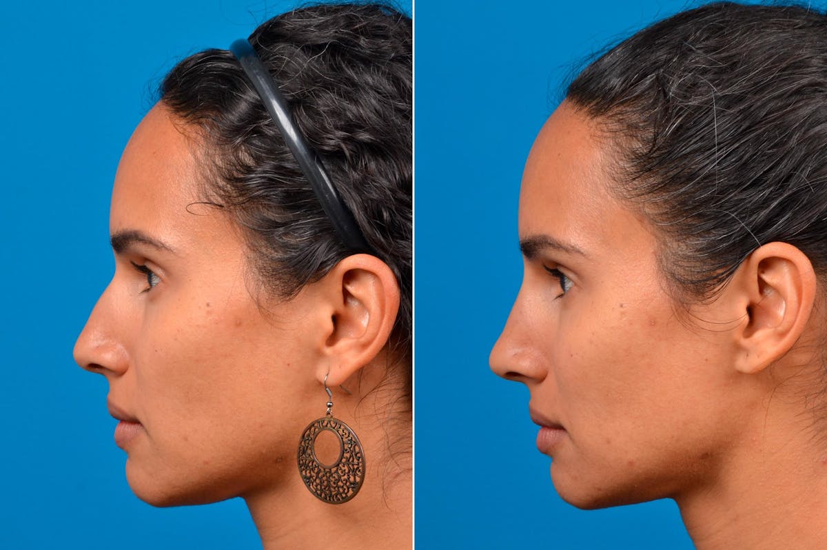 Liquid Rhinoplasty Before & After Gallery - Patient 122406148 - Image 5