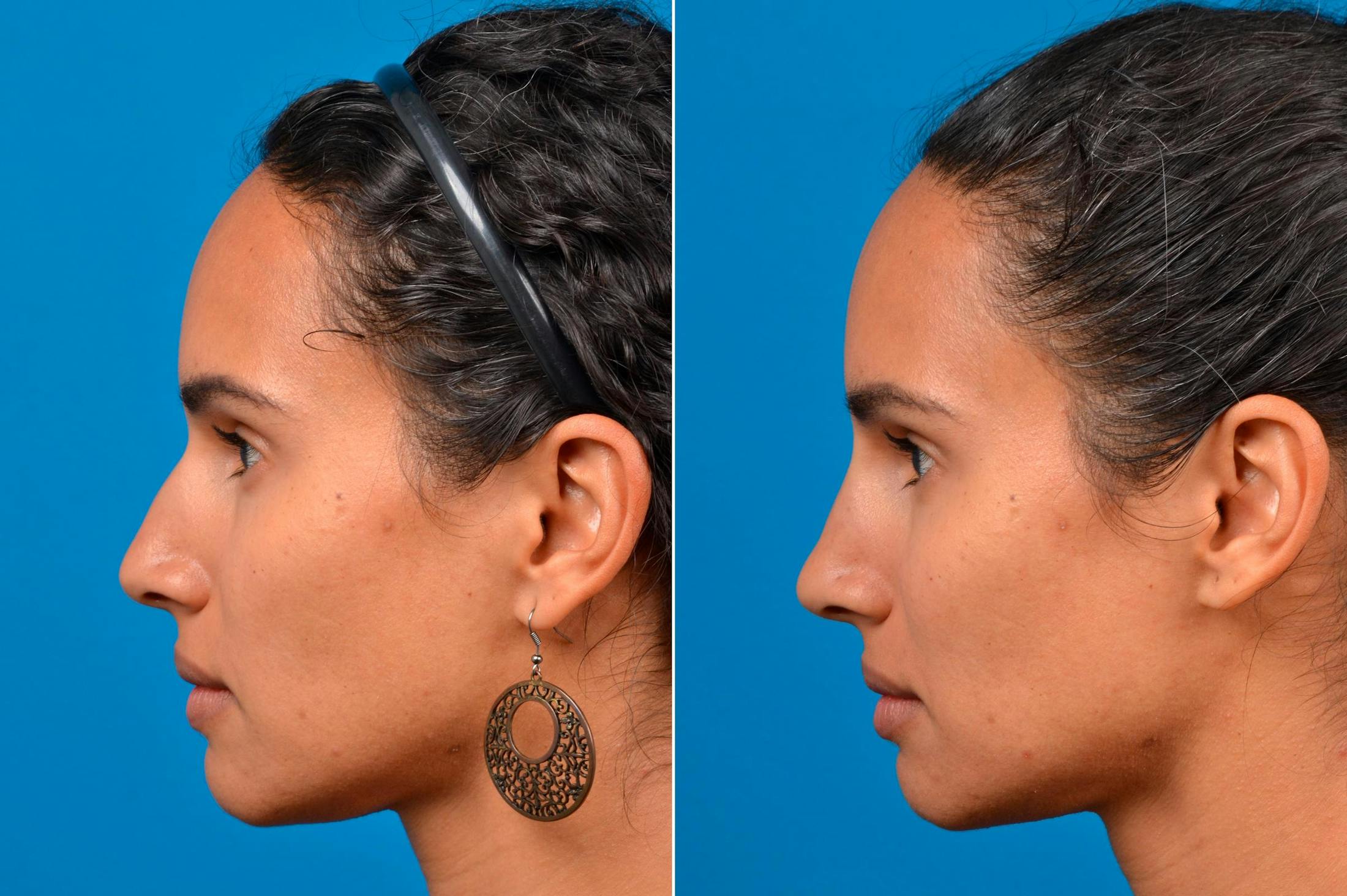 Liquid Rhinoplasty Before & After Gallery - Patient 122406148 - Image 5