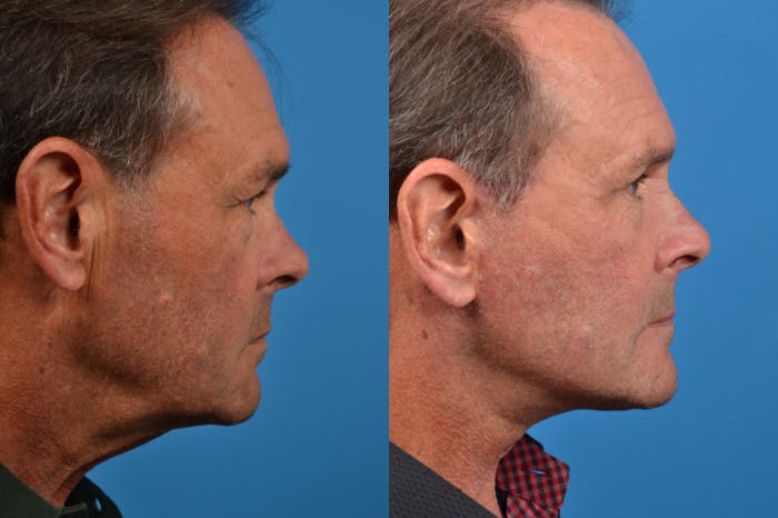 Facelift Before & After Gallery - Patient 122406149 - Image 5