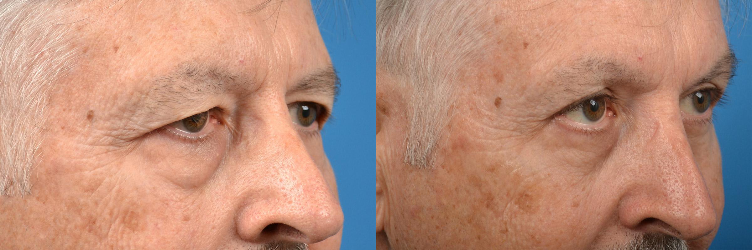 Eyelid Surgery Before & After Gallery - Patient 400054 - Image 2