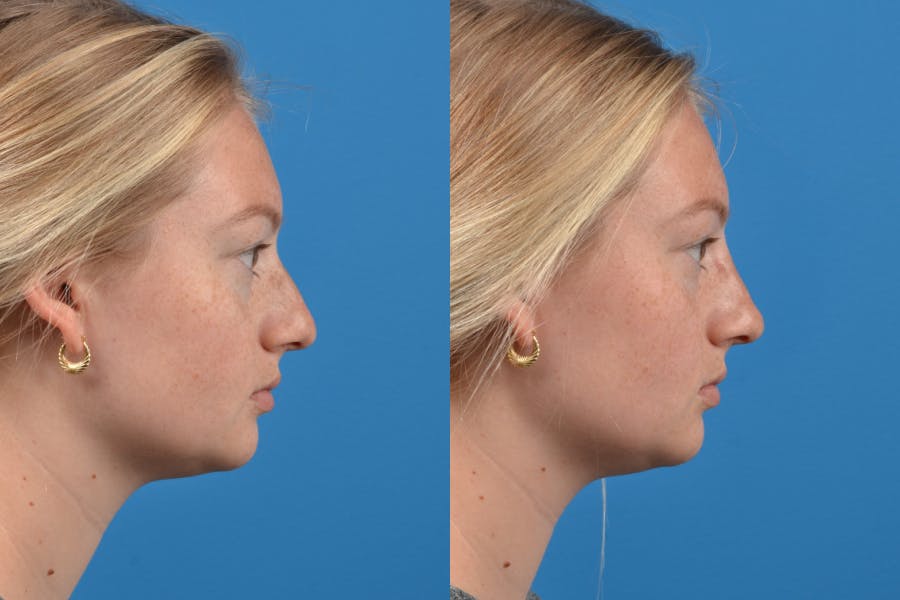 Liquid Rhinoplasty Before & After Gallery - Patient 122406152 - Image 1