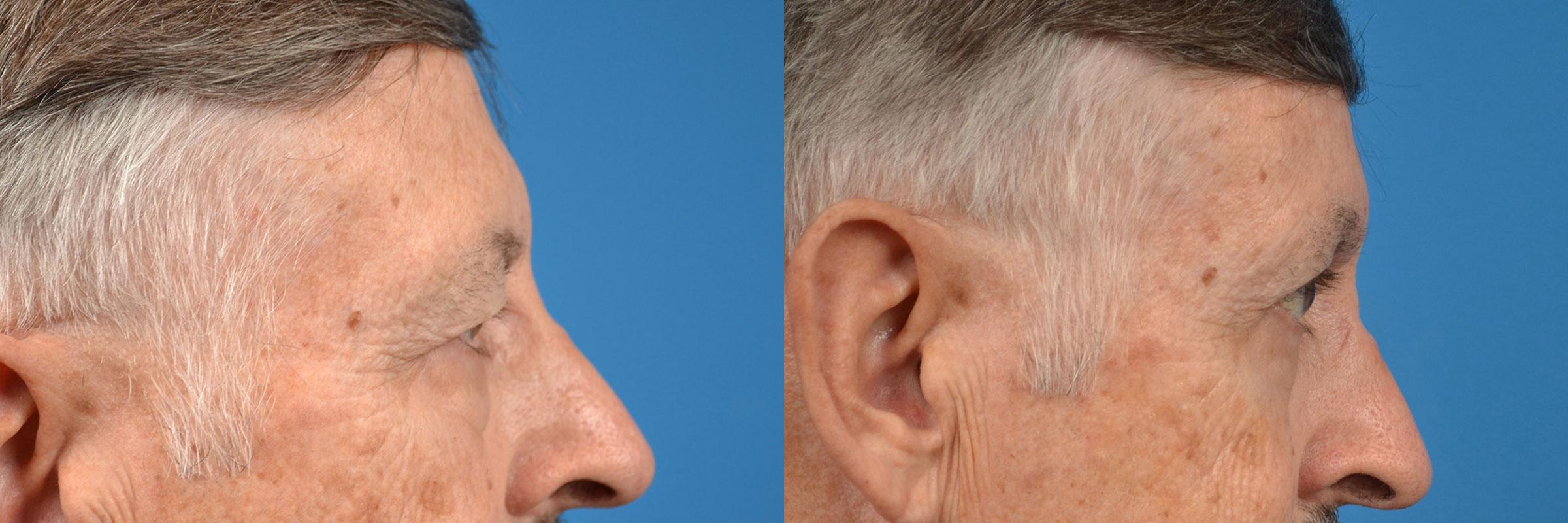 Eyelid Surgery Before & After Gallery - Patient 400054 - Image 3