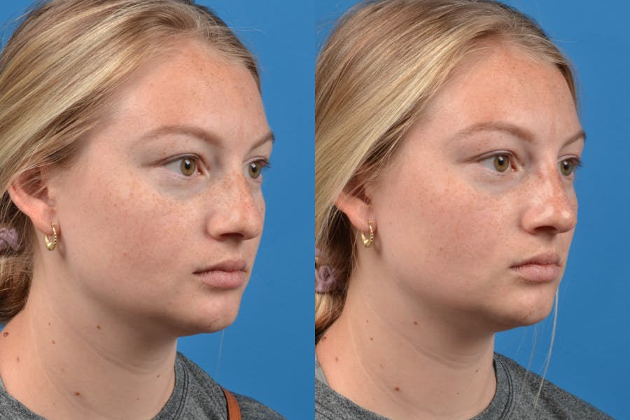 Liquid Rhinoplasty Before & After Gallery - Patient 122406152 - Image 2