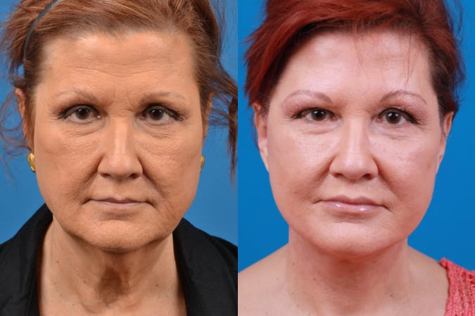Facelift Before & After Gallery - Patient 122406153 - Image 1