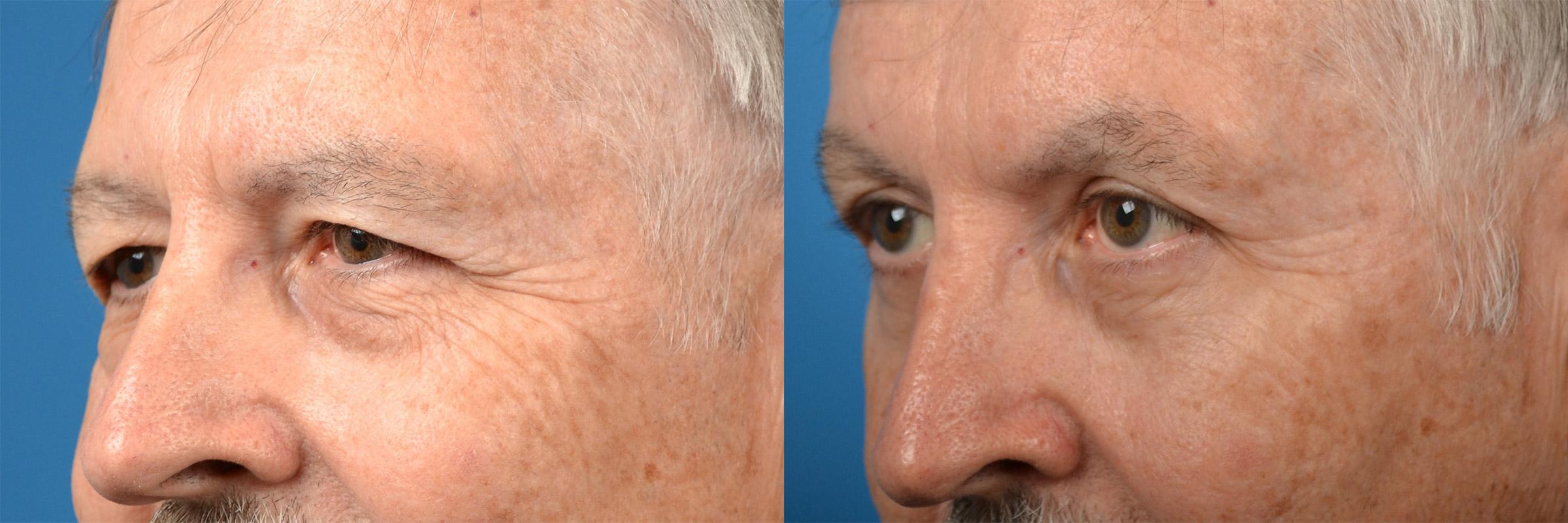 Eyelid Surgery Before & After Gallery - Patient 400054 - Image 4