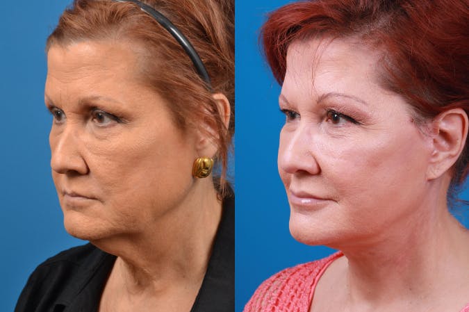 Facelift Before & After Gallery - Patient 122406153 - Image 2