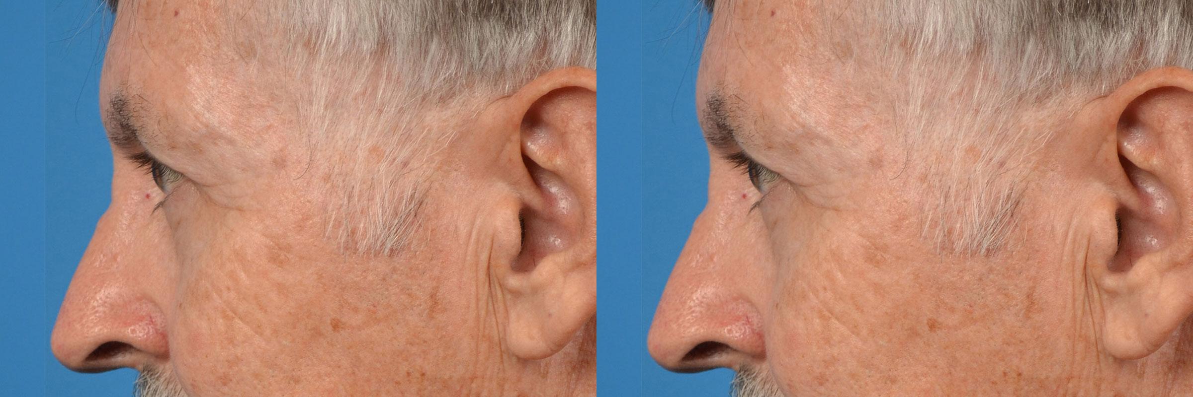 Eyelid Surgery Before & After Gallery - Patient 400054 - Image 5
