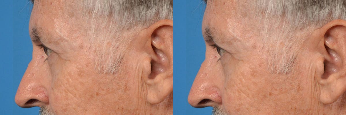 Eyelid Surgery Before & After Gallery - Patient 122406151 - Image 5