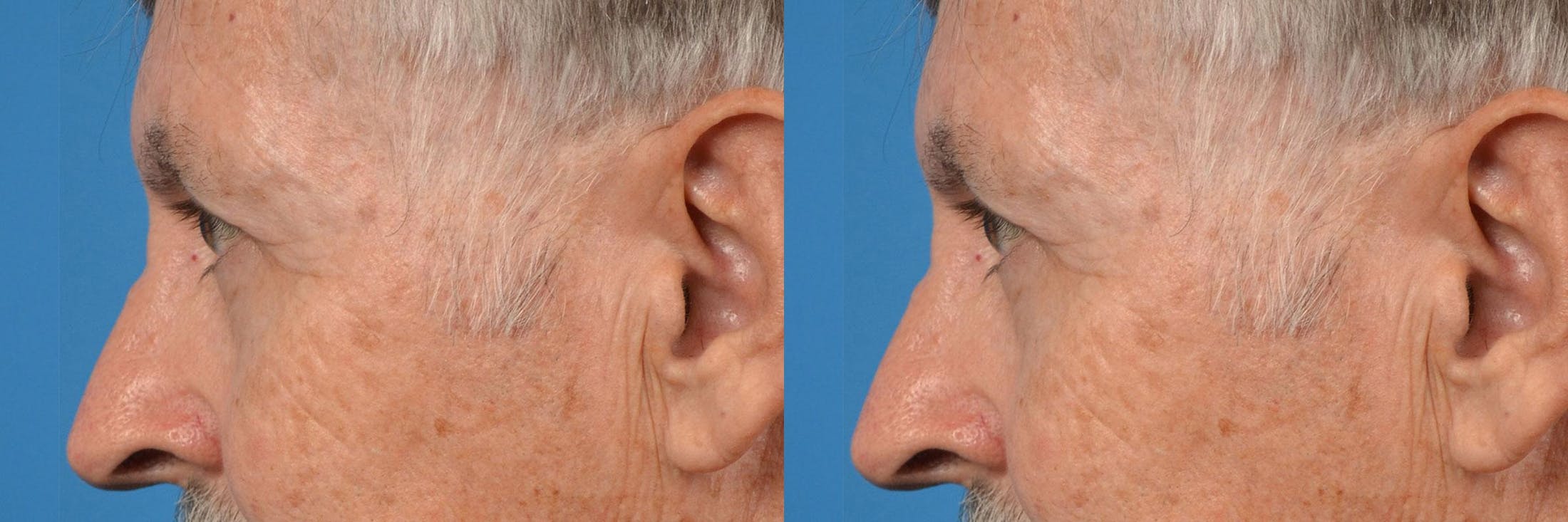 Eyelid Surgery Before & After Gallery - Patient 122406151 - Image 5