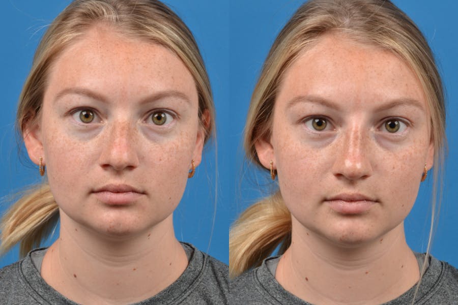 Liquid Rhinoplasty Before & After Gallery - Patient 122406152 - Image 3