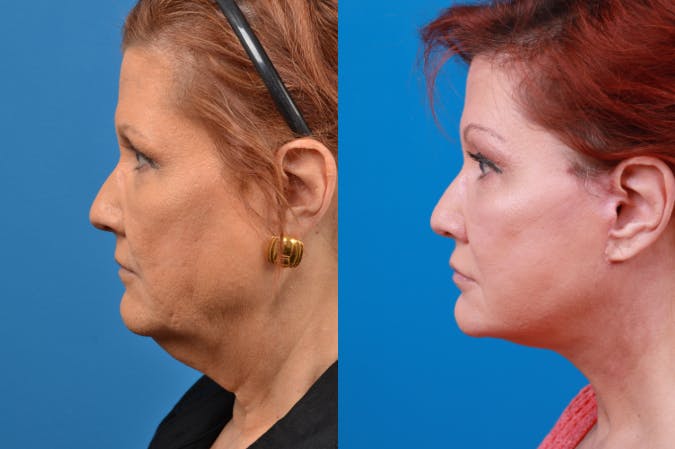 Facelift Before & After Gallery - Patient 122406153 - Image 3