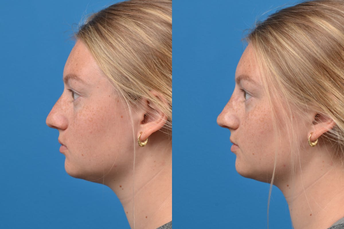 Liquid Rhinoplasty Before & After Gallery - Patient 122406152 - Image 4