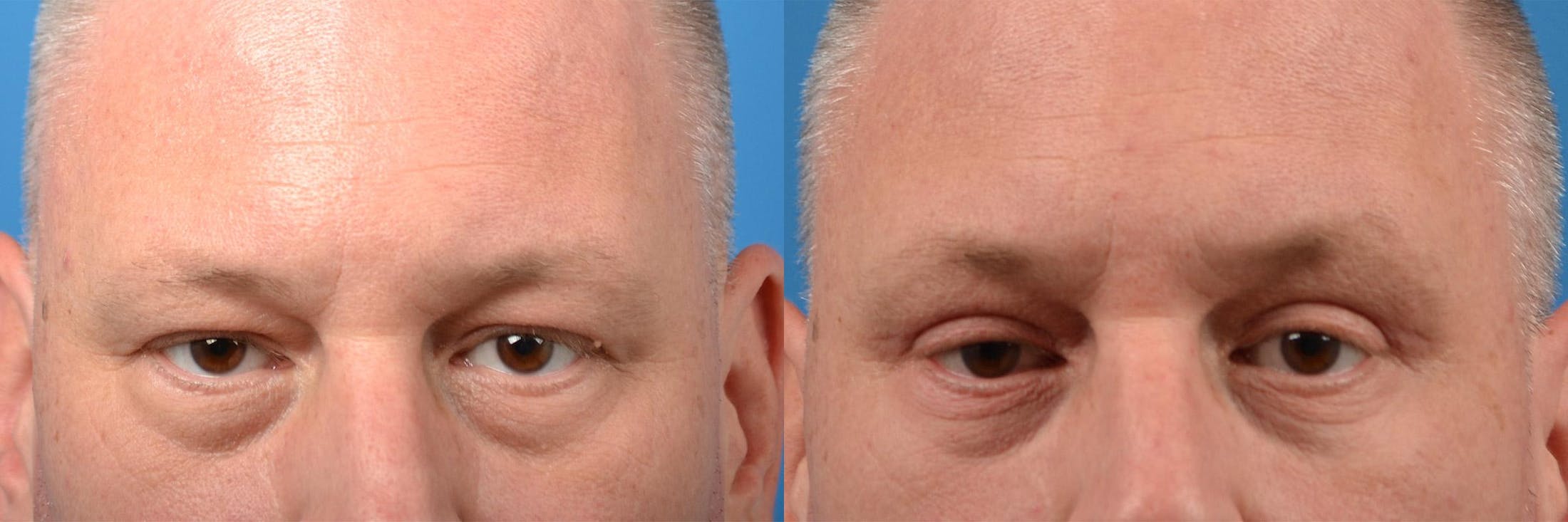 Eyelid Surgery Before & After Gallery - Patient 122406154 - Image 1