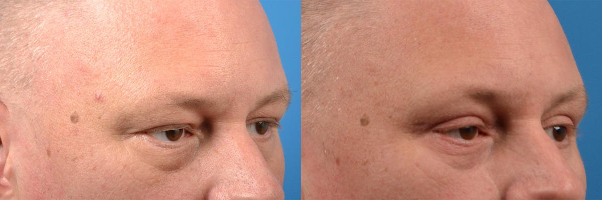 Eyelid Surgery Before & After Gallery - Patient 122406154 - Image 2