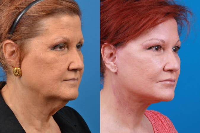 Facelift Before & After Gallery - Patient 122406153 - Image 4
