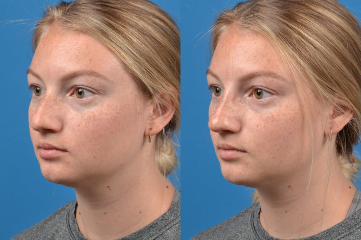 Liquid Rhinoplasty Before & After Gallery - Patient 122406152 - Image 5